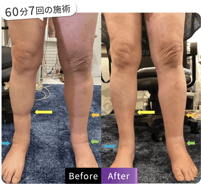 60分7回の施術
